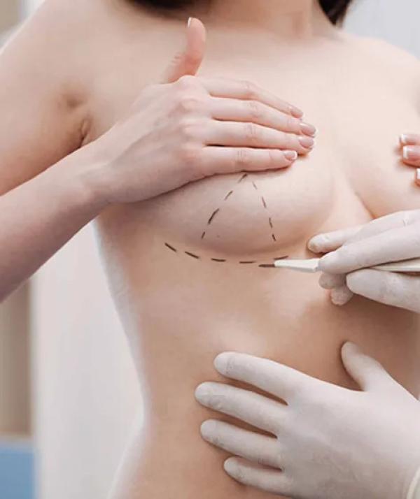  Breast Lift (Mastopexy)