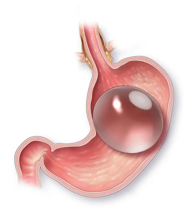 Gastric Balloon